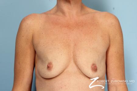 Breast Augmentation: Patient 38 - Before Image 1