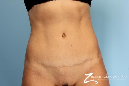 Tummy Tuck: Patient 14 - After Image 1
