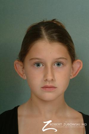 Otoplasty: Patient 3 - Before Image 1