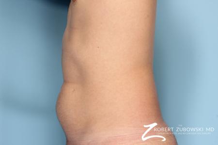 Liposuction: Patient 16 - Before and After Image 2