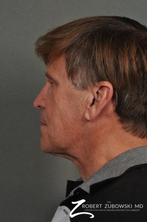 Neck Lift: Patient 3 - After Image 3
