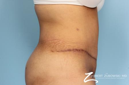 Tummy Tuck: Patient 15 - After Image 2
