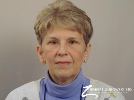 Blepharoplasty: Patient 20 - After Image 1