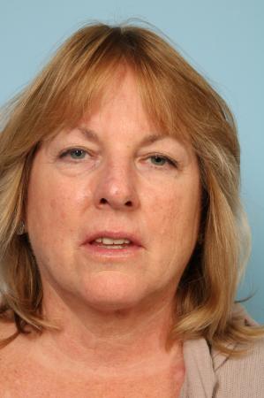 Mohs Closure: Patient 1 - After Image 2