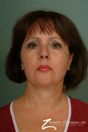 Neck Lift: Patient 8 - After Image 1
