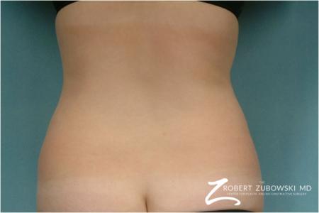 Liposuction: Patient 35 - Before Image 1