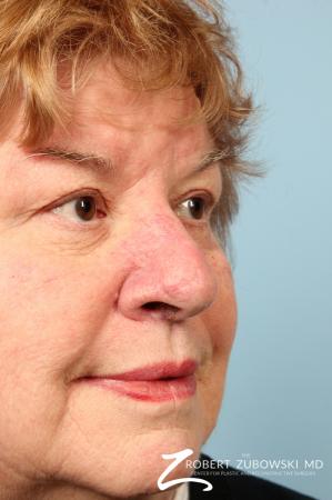 Mohs Closure: Patient 6 - After Image 1