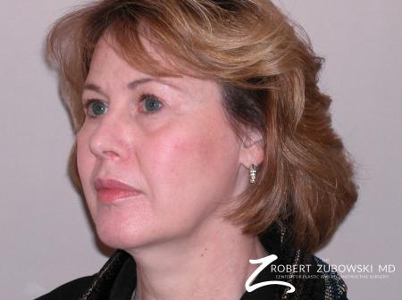 Facelift: Patient 1 - Before and After Image 2