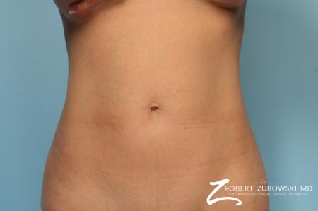 CoolSculpting®: Patient 6 - After Image 2