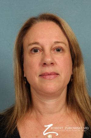 Neck Lift: Patient 5 - After Image 1