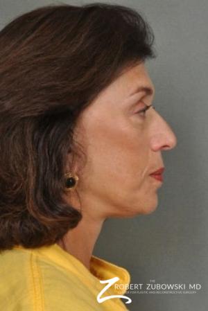 Facelift: Patient 6 - After Image 2