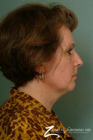 Neck Lift: Patient 8 - Before and After Image 3
