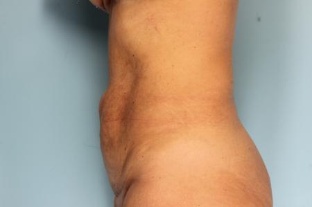 Tummy Tuck: Patient 23 - Before and After Image 3