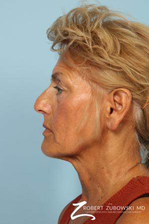 Facelift: Patient 27 - Before and After Image 2