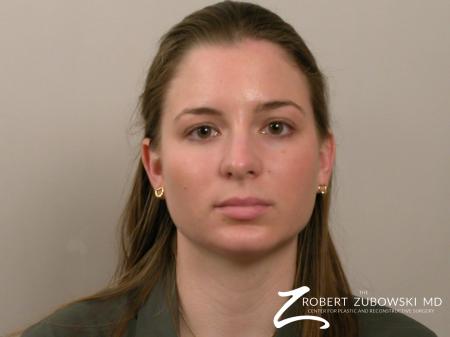Chin Augmentation: Patient 1 - After Image 1