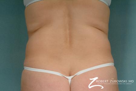 Liposuction: Patient 33 - Before Image 3