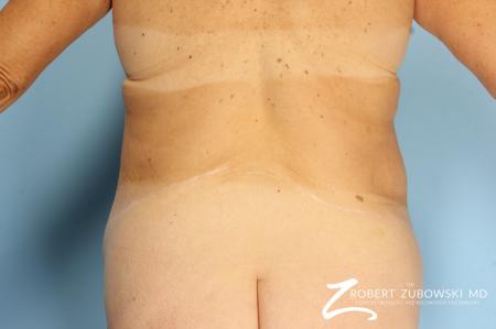 CoolSculpting®: Patient 2 - After Image 5