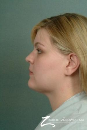 Liposuction: Patient 5 - After Image 2