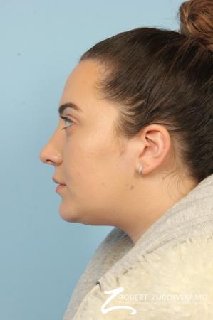 Rhinoplasty: Patient 21 - After Image 2