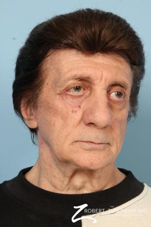 Mohs Closure: Patient 4 - After Image 1