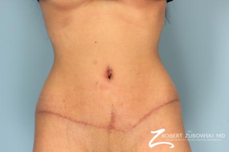 Tummy Tuck: Patient 8 - After Image 1