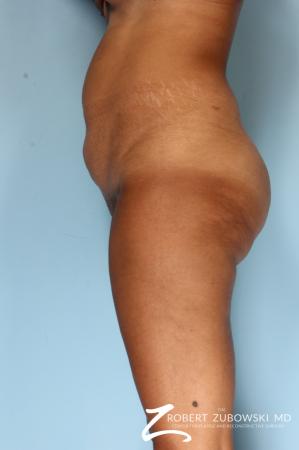 Liposuction: Patient 49 - Before Image 3