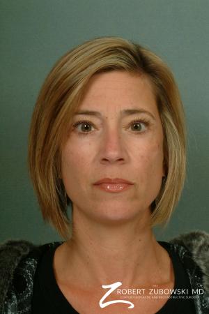 Chemical Peel: Patient 2 - After Image 1