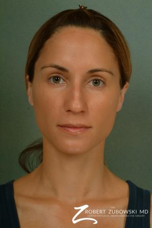Rhinoplasty: Patient 4 - Before Image 1