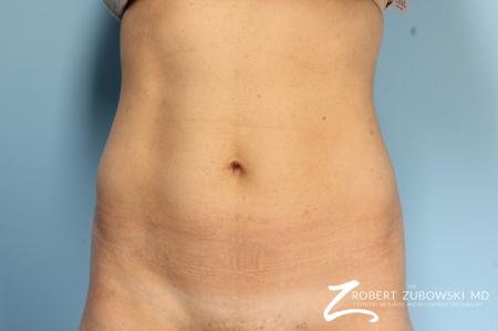 CoolSculpting®: Patient 5 - Before Image 1