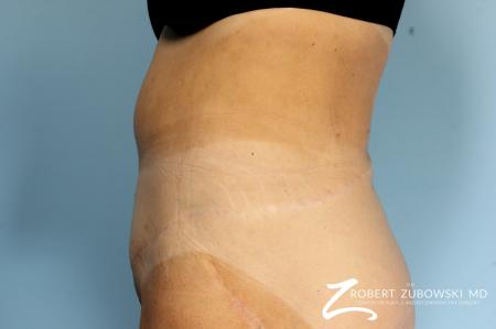 CoolSculpting®: Patient 2 - Before Image 4