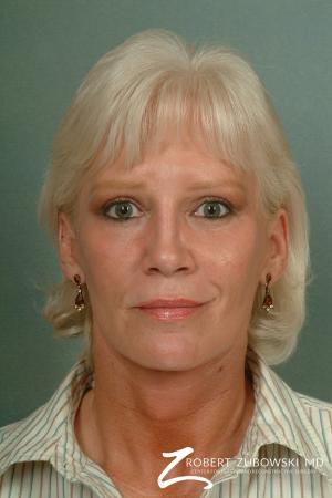 Facelift: Patient 7 - After Image 1