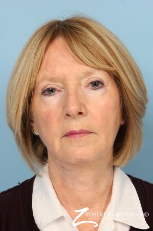 Facelift: Patient 20 - Before Image 1