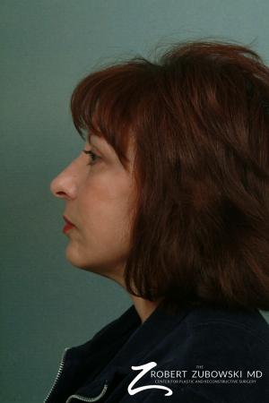 Facelift: Patient 2 - After Image 2