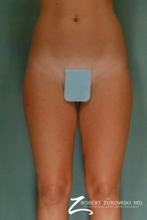 Liposuction: Patient 7 - Before Image 1