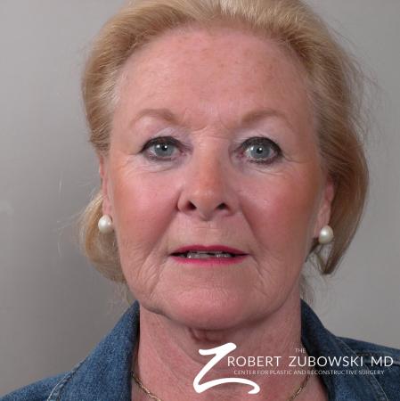 Facelift: Patient 16 - Before Image 1