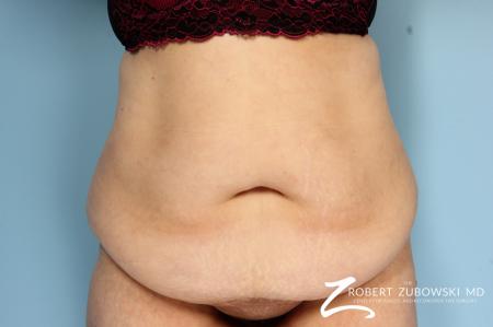 Body Lift: Patient 4 - Before Image 1
