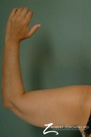 Liposuction: Patient 23 - Before Image 1