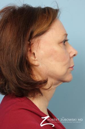 Facelift: Patient 17 - Before and After Image 2