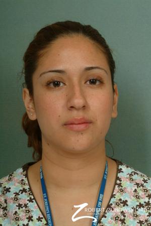 Rhinoplasty: Patient 13 - Before Image 1