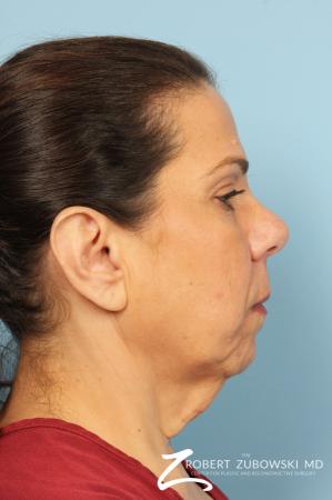 Chin Augmentation: Patient 4 - Before Image 2