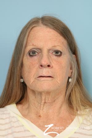 Blepharoplasty: Patient 38 - After Image 1