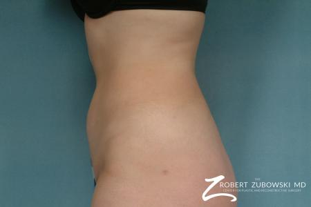 Liposuction: Patient 29 - After Image 4