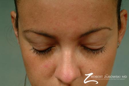 Latisse: Patient 1 - After Image 1
