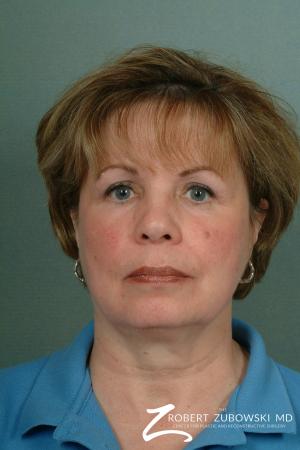 Chin Augmentation: Patient 2 - Before Image 1
