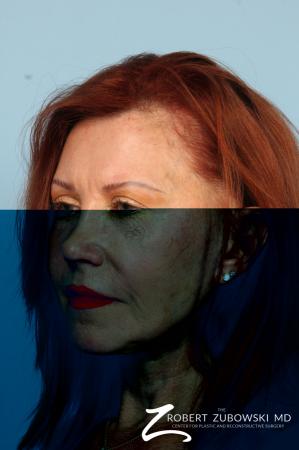 Facelift: Patient 29 - Before and After Image 3