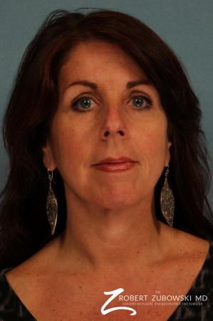 Neck Lift: Patient 4 - After Image 1