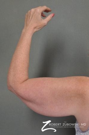 Arm Lift: Patient 1 - Before and After Image 2