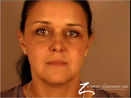 Brow Lift: Patient 3 - After Image 1
