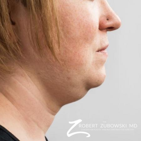 CoolSculpting®: Patient 1 - Before and After Image 2