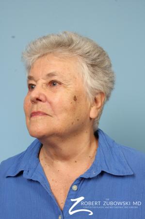 Mohs Closure: Patient 3 - After Image 2